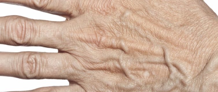 Wrinkled Hands Causes, Concerns And Treatment